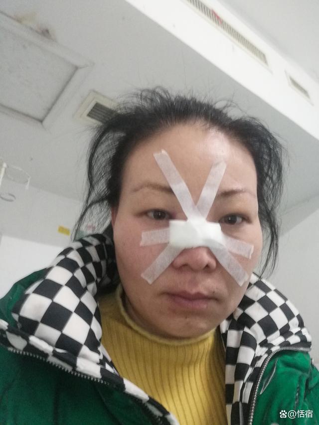 女子鼻骨骨折消肿后重塑自信美丽，高鼻梁重塑自信之旅