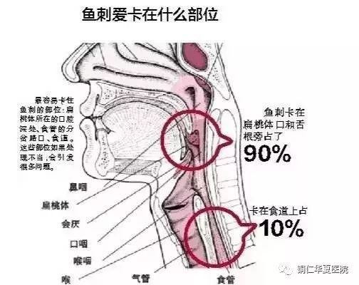 鱼刺卡喉能否吃馒头应对？误解与正确处理方法探讨