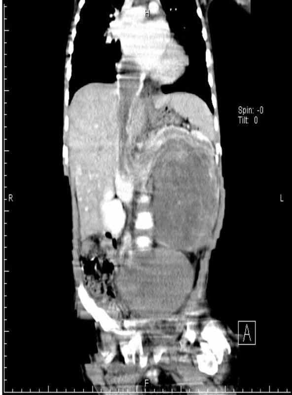 男童生吃蟹腿引发寄生虫入侵心脏，食品安全与健康风险需警惕