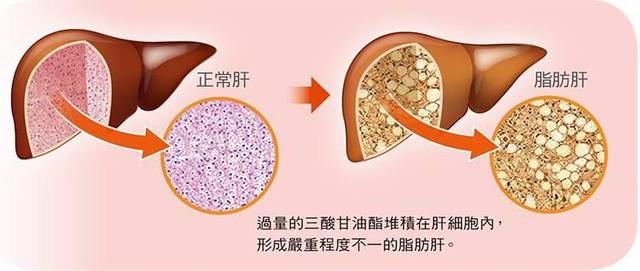 男子因过度节食治疗脂肪肝导致脂肪暴增，健康之路需审慎选择