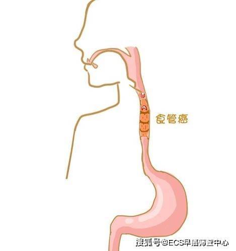 夫妻俩因为同一个习惯双双确诊食管癌